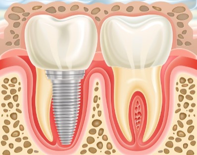 Invisible Braces