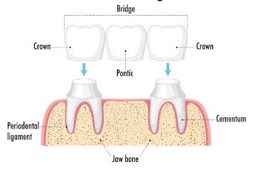 Invisible Braces