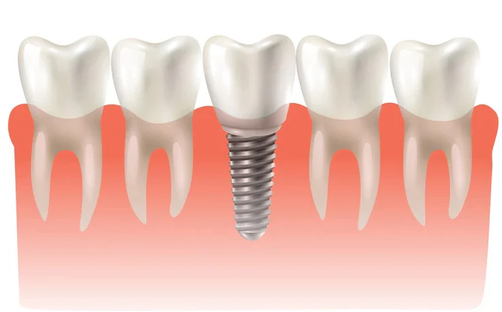 Dental Implants